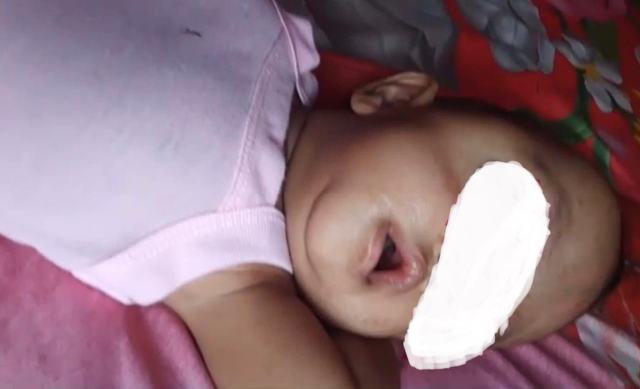 Pemkab dan DPRD Madina Galang Donasi Pengobatan Anak Idap Kanker Mata